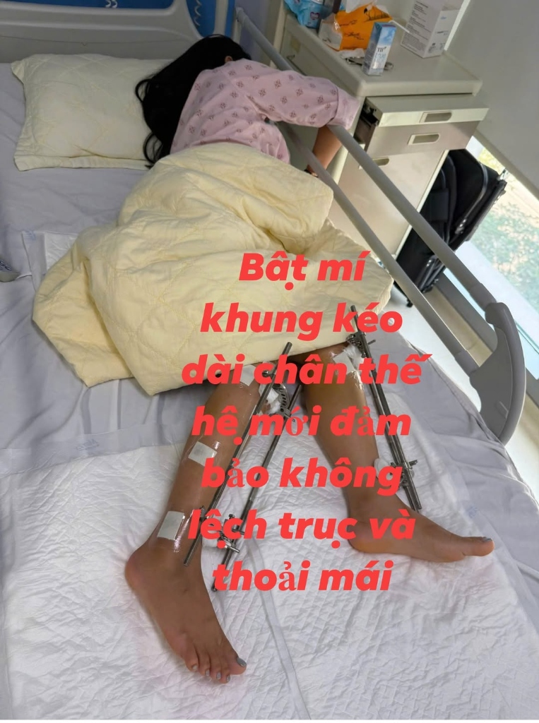 Đeo khung Ilizarov kéo dài xương